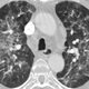 CT scan of inflamed lungs of a patient suffering form HP. (Image: M. Funke, J-M. Fellrath/European Respiratory Journal.